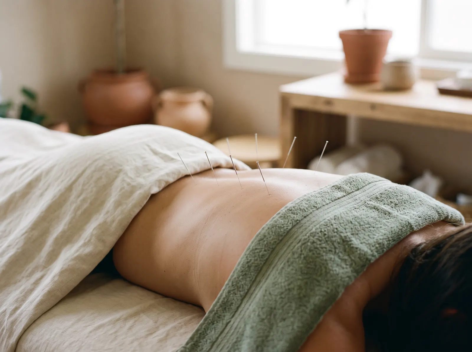Fine acupuncture needles placed along a patient's back